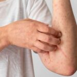 Kemenkes Sediakan Vaksin Cacar Monyet untuk Kelompok Berisiko