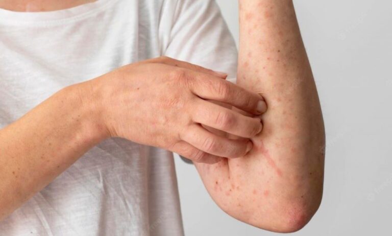 Kemenkes Sediakan Vaksin Cacar Monyet untuk Kelompok Berisiko