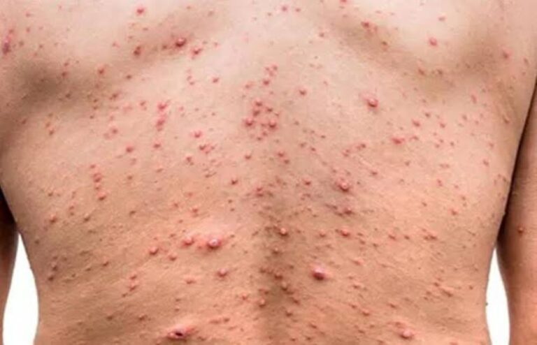 Pemerintah Didesak Perluas Kebijakan Vaksinasi Cacar Monyet