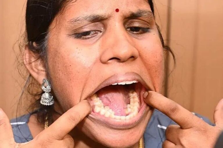 Dianugerahi Rekor Dunia, Wanita India Ini Punya 38 Gigi di Mulutnya